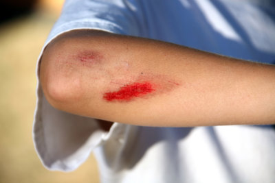wounded elbow